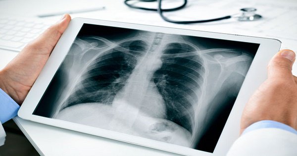 Chụp X quang có ảnh hưởng gì tới sức khỏe không?