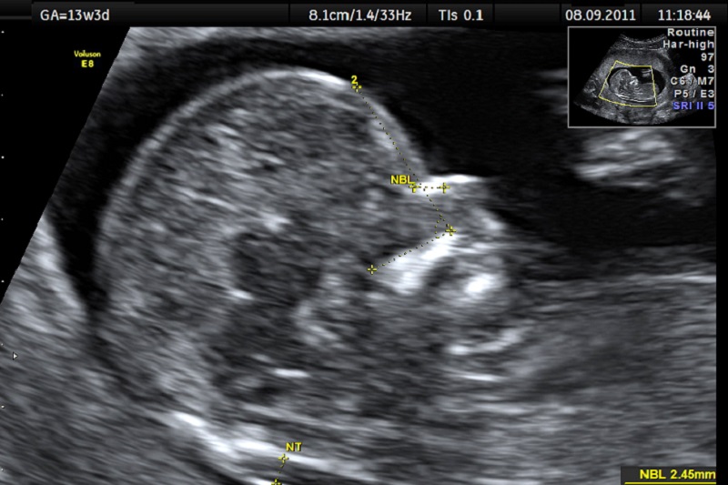 Những thông tin về phương pháp siêu âm phát hiện dị tật thai nhi